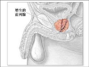 前列腺偏大是什么原因